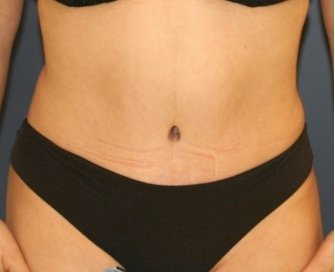 Tummy Tuck 229 - after - front