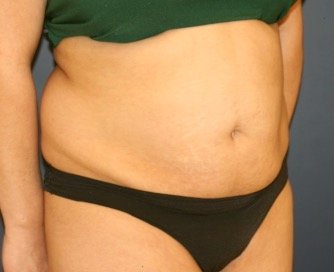 Tummy Tuck 229 - before - oblique