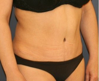 Tummy Tuck 229 - after - oblique