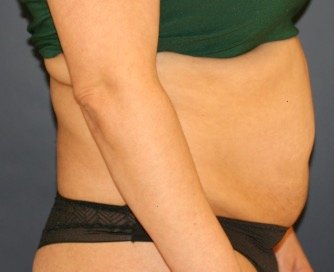 Tummy Tuck 229 - before - side