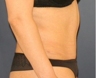 Tummy Tuck 229 - after - side