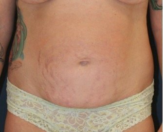 Tummy Tuck 230 - before - front