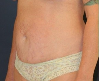 Tummy Tuck 230 - before - oblique