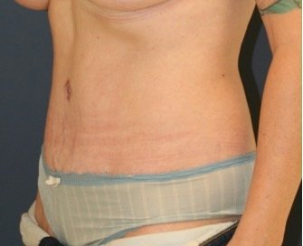 Tummy Tuck 230 - after - oblique