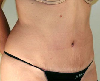 Tummy Tuck Case 7 - after - angle