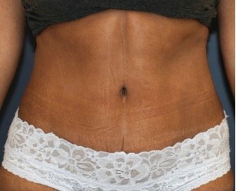 Tummy Tuck 231 - after - front