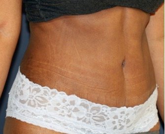 Tummy Tuck 231 - after - oblique