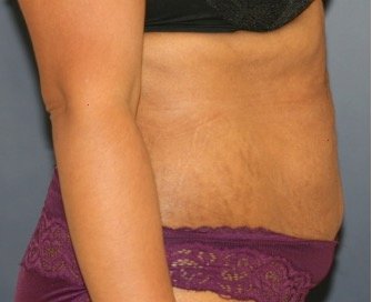 Tummy Tuck 231 - before - side