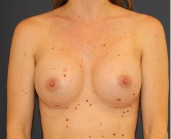Breast Augmentation 143 - after - front