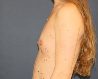 Breast Augmentation 143 - before - side