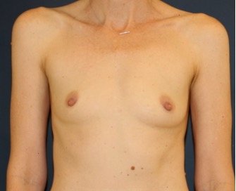 Breast Augmentation 144 - before - front