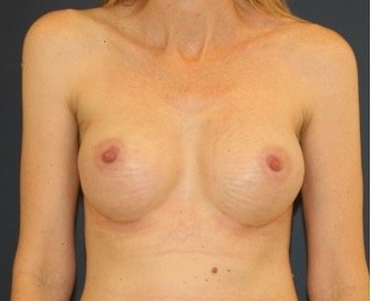 Breast Augmentation 144 - after - front