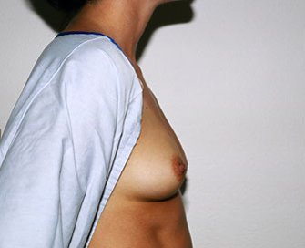 Breast Augmentation Case 43 - before - side