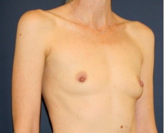 Breast Augmentation 144 - before - oblique