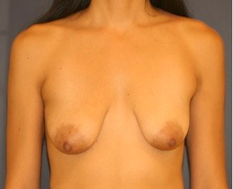 Breast Lift 306 - before - front