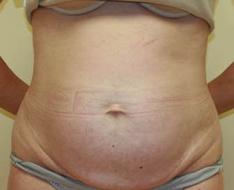 Tummy Tuck Case 25 - before - front