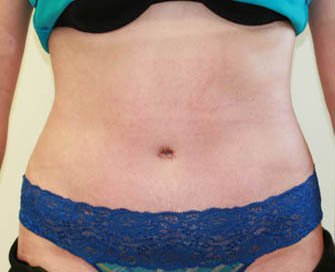 Tummy Tuck Case 25 - after - front