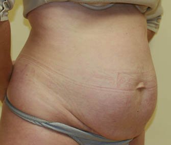 Tummy Tuck Case 25 - before - oblique