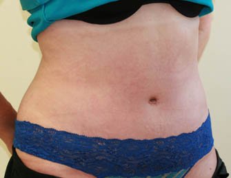 Tummy Tuck Case 25 - after - oblique