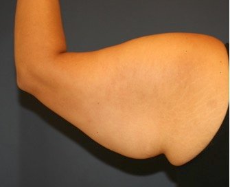Arm Reduction 209 - before - front