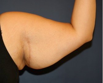 Arm Reduction 209 - before - oblique