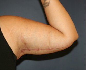 Arm Reduction 209 - after - oblique