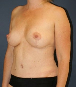 Mommy Makeover 213 - after - oblique