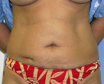 Tummy Tuck Case 8 - before - front