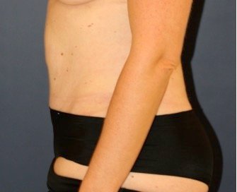 Tummy Tuck 232 - after - front