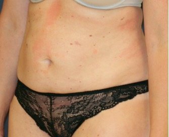 Tummy Tuck 232 - before - oblique