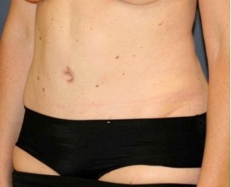 Tummy Tuck 232 - after - oblique