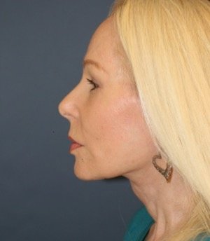 Facelift 103 - after - oblique
