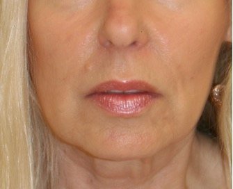 Corner Lip Lift 210 - before - front