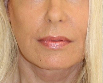 Corner Lip Lift 210 - after - front