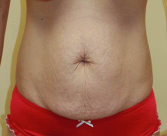 Tummy Tuck Case 26 - before - front