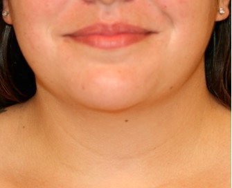 Neck Liposuction 208 - before - front