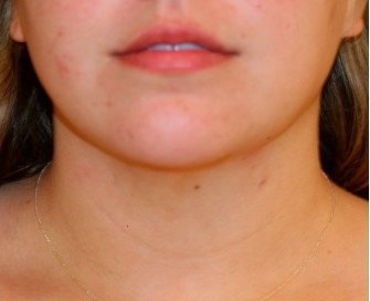 Neck Liposuction 208 - after - front