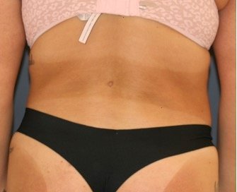 Liposuction Waist-Flanks 209 - after - front