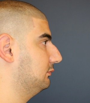 Rhinoplasty 207 - before - front