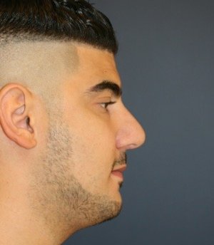 Rhinoplasty 207 - after - front
