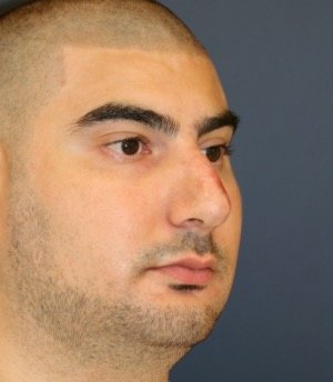 Rhinoplasty 207 - before - oblique