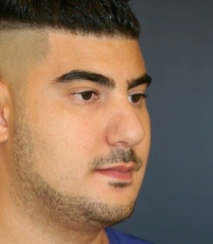 Rhinoplasty 207 - after - oblique