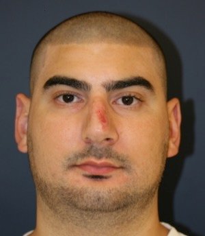 Rhinoplasty 207 - before - side