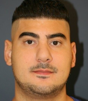 Rhinoplasty 207 - after - side