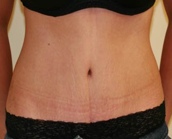 Tummy Tuck Case 26 - after - front