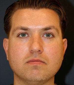 Rhinoplasty 208 - before - front