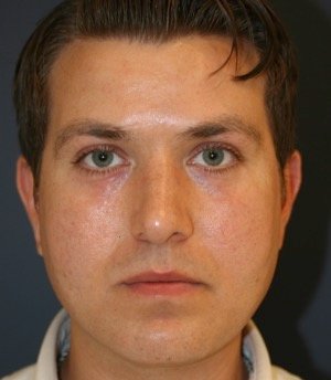 Rhinoplasty 208 - after - front