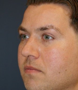 Rhinoplasty 208 - before - oblique