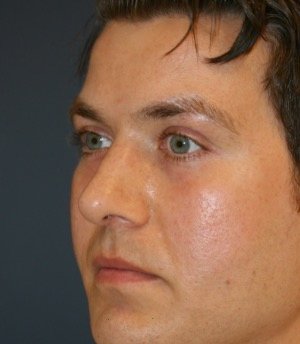 Rhinoplasty 208 - after - oblique