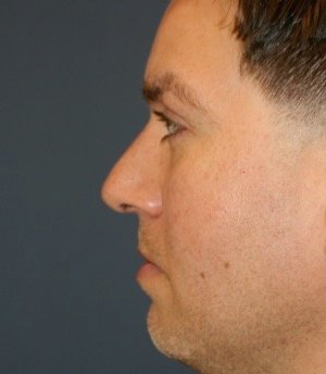 Rhinoplasty 208 - before - side